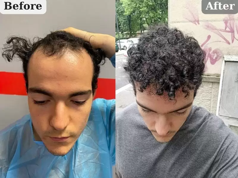 itariaren-huan-zhe-nizarushi-8keyue-italyan-hasta-nizar-bey-8-ay