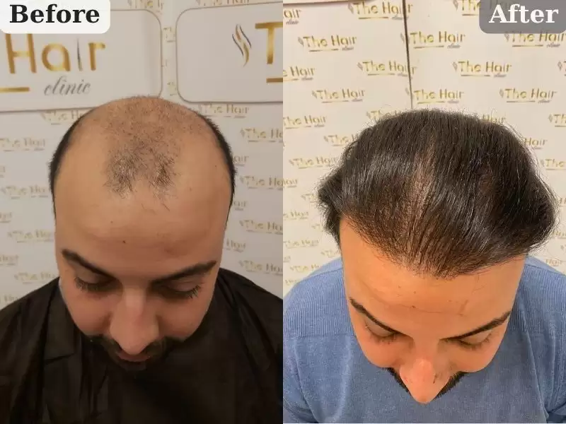 iruhaniremuyusemarutakaralai-tahuan-zhe-ilhan-irem-yuce-maltadan-gelen-hastamiz