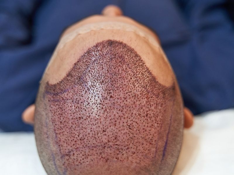植毛後のかゆみと赤みは正常か